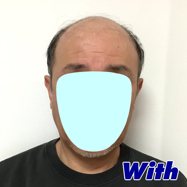 13a240324a_男性用かつらオーダーメイド装着前1