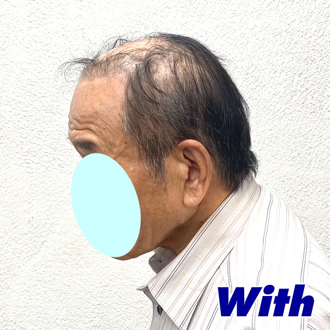 16a240307a_男性用かつらオーダーメイド装着前3