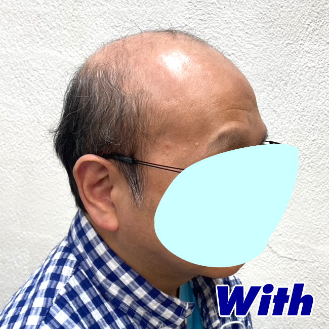16a240316a_男性用かつらオーダーメイド装着前2