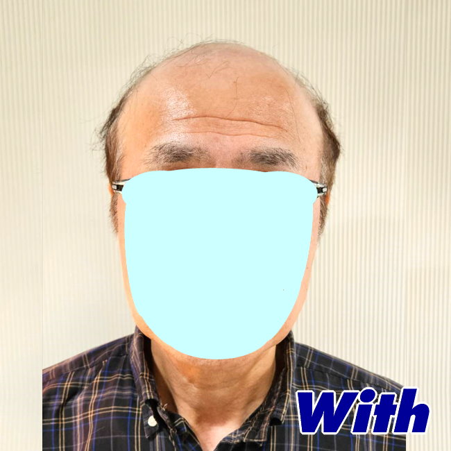 202240311a_男性用かつらオーダーメイド装着前1