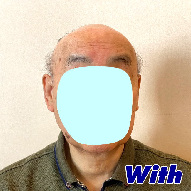209240308a_男性用かつらオーダーメイド装着前1