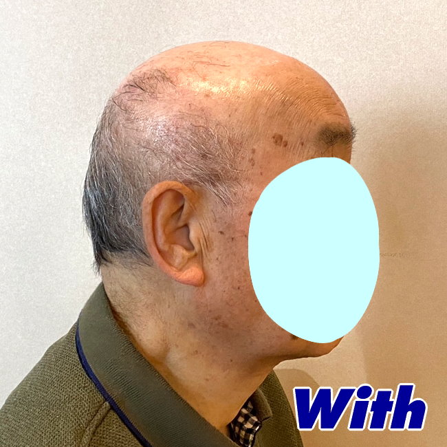 209240308a_男性用かつらオーダーメイド装着前2