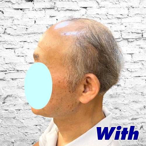 210240323a_男性用かつらオーダーメイド装着前2