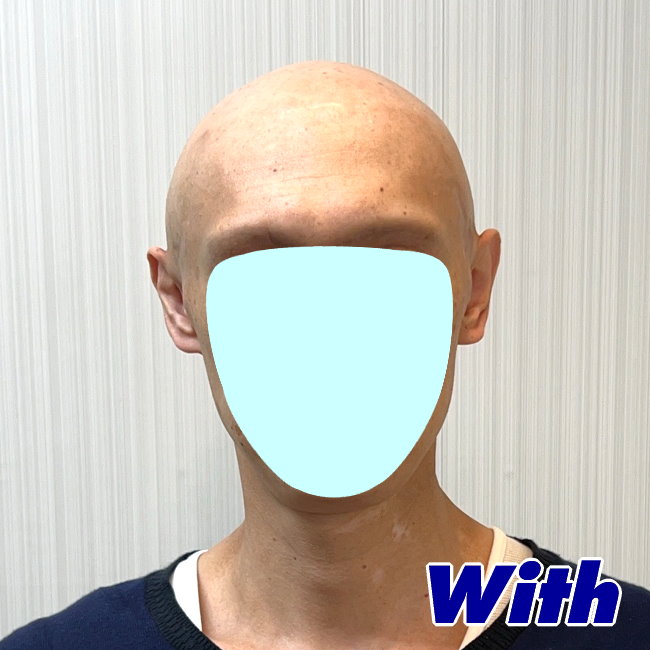 222240331a_男性医療用かつらオーダーメイド装着前1