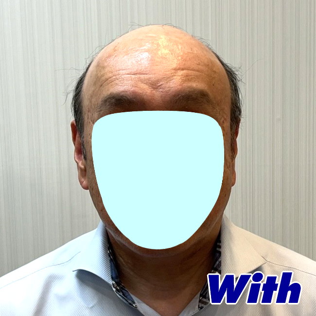 222240405a_男性用かつらオーダーメイド装着前1