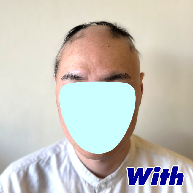 227240518a_男性向け医療用かつら装着前1