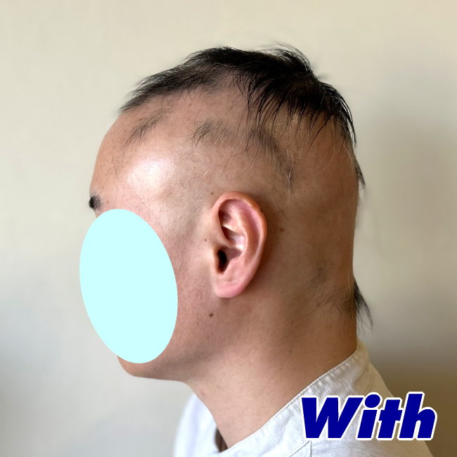 227240518a_男性向け医療用かつら装着前2