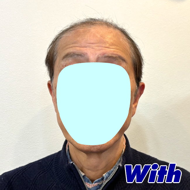 229240307a_男性用かつらオーダーメイド装着前1
