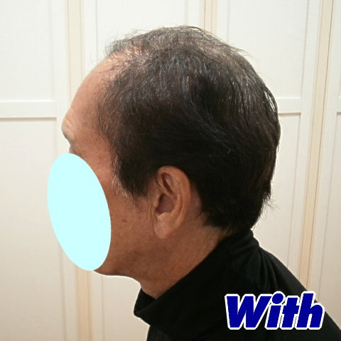 231240308a_男性用かつらオーダーメイド装着前1
