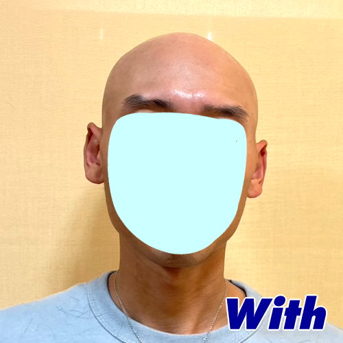 53a240518a_男性向け医療用かつら装着前1