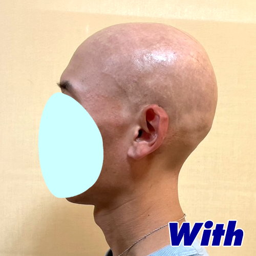 53a240518a_男性向け医療用かつら装着前2