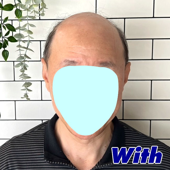 54a240226a_男性用かつらオーダーメイド装着前1