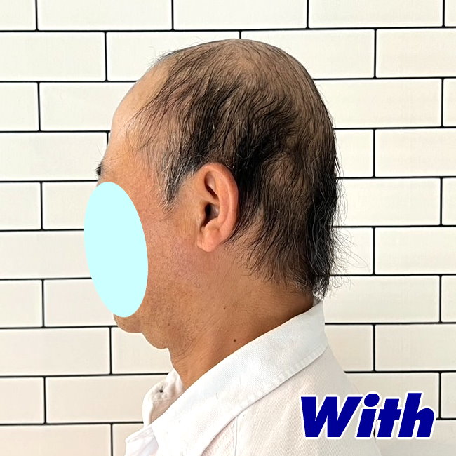 54a240411a_男性用かつらオーダーメイド装着前2