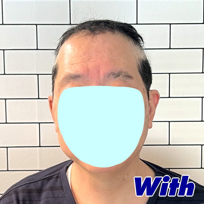 54a240601a_男性向け医療用かつら装着前1