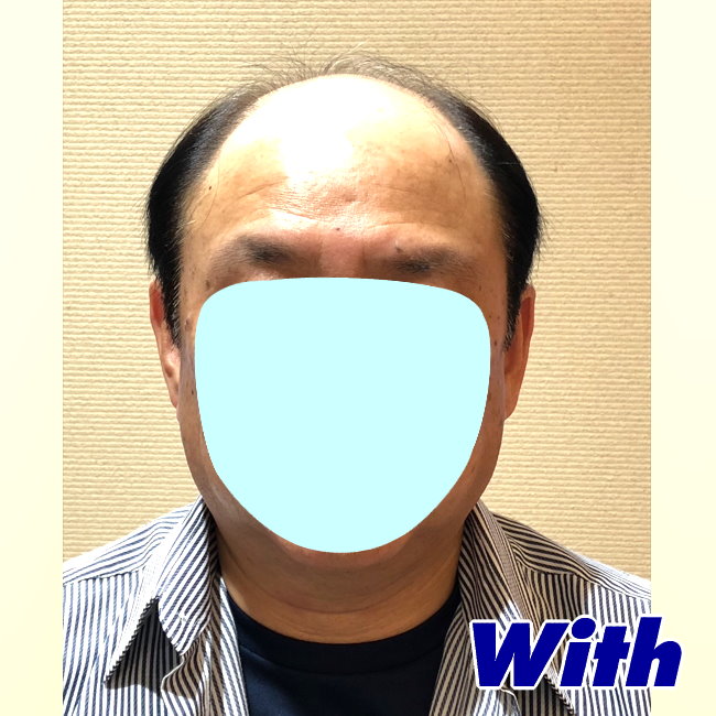 66a240327a_男性用かつらオーダーメイド装着前1