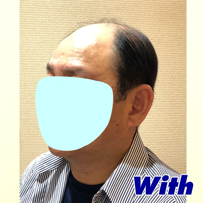 66a240327a_男性用かつらオーダーメイド装着前2