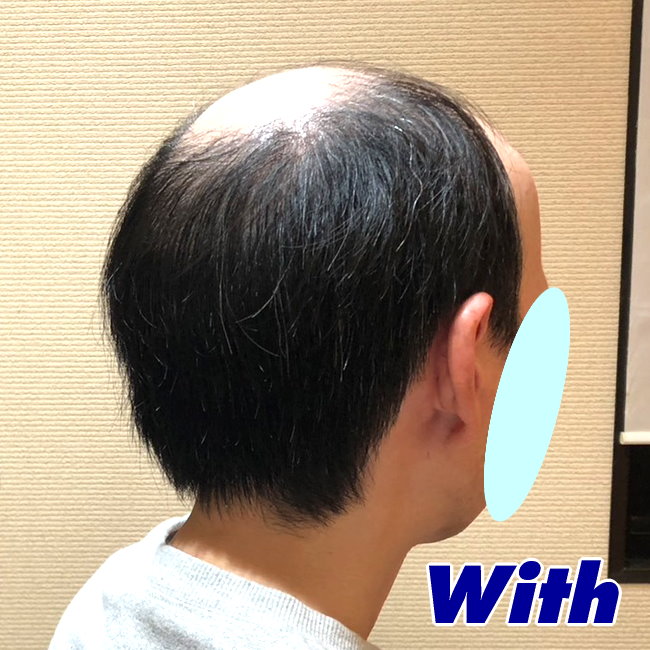 66a240608a_男性用かつらオーダーメイド装着前3