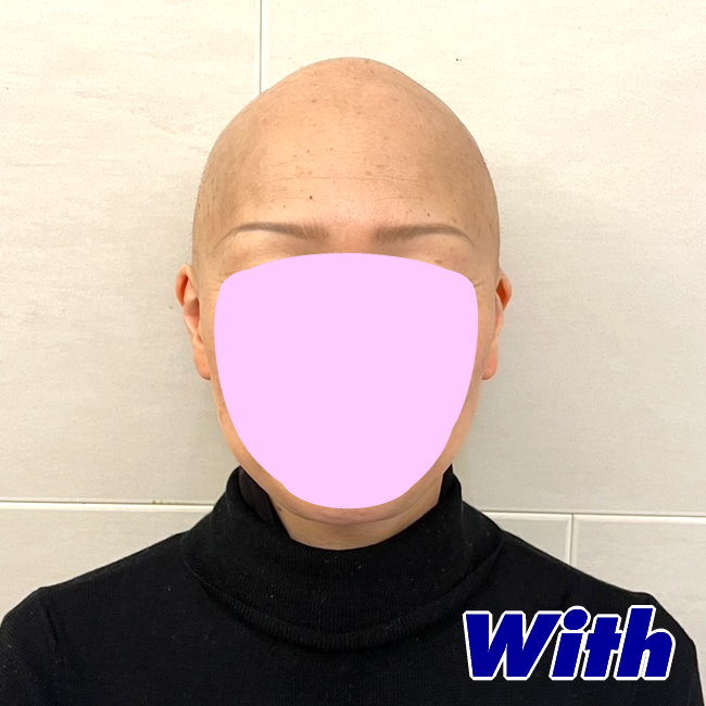 207240227a_女性向け医療用ウィッグ着用前ビフォー1